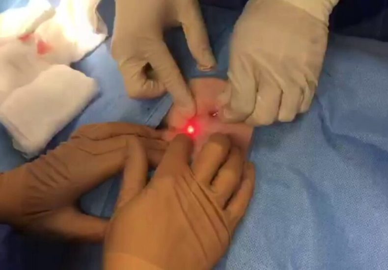 Benefits of pilonidal cyst treatment with laser in Tehran